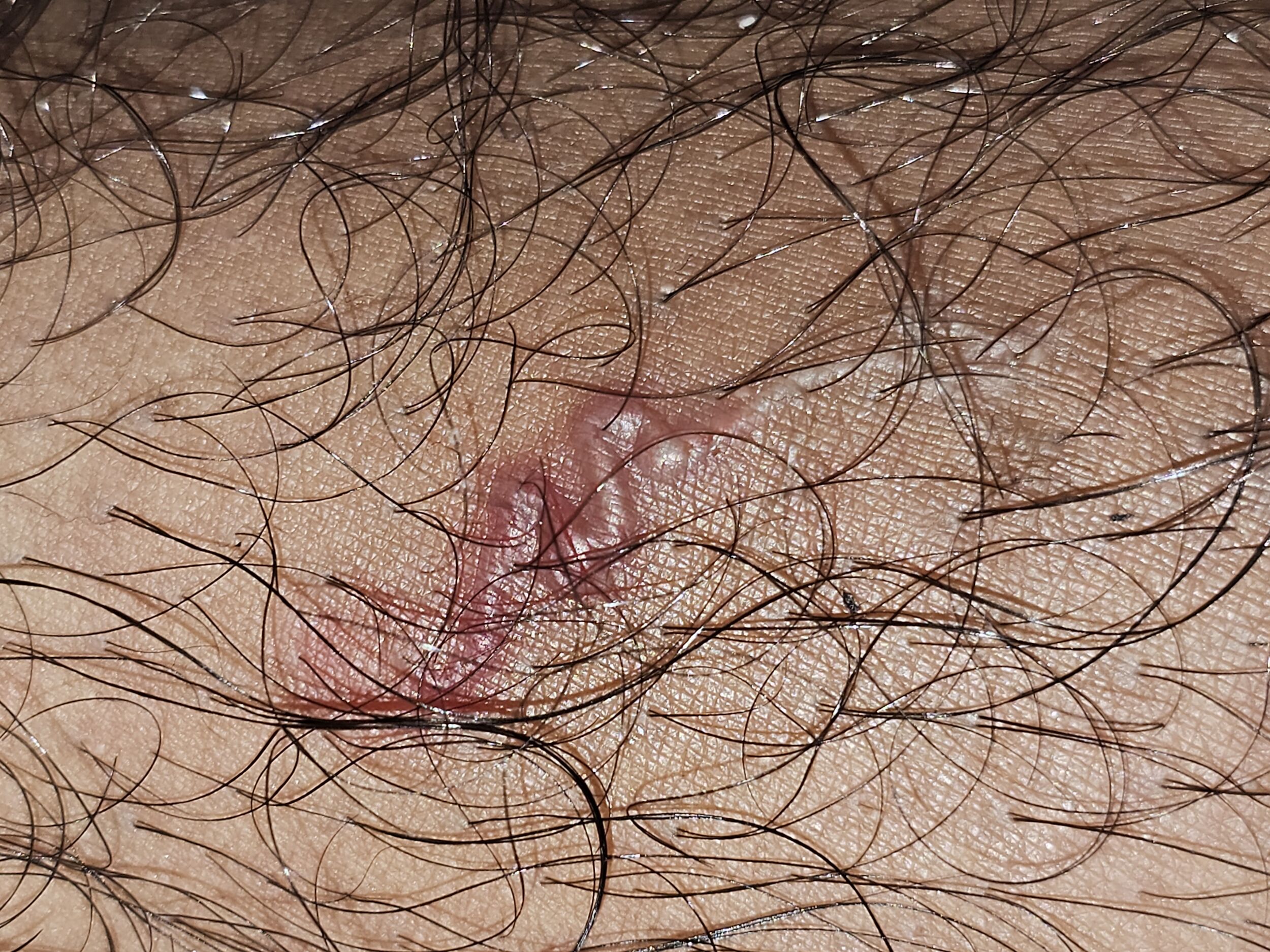 18-the-rash-that-crawled-dr-chetan-k-ganteppanavars-encounter-with-a-rare-diagnosis-thumbnail