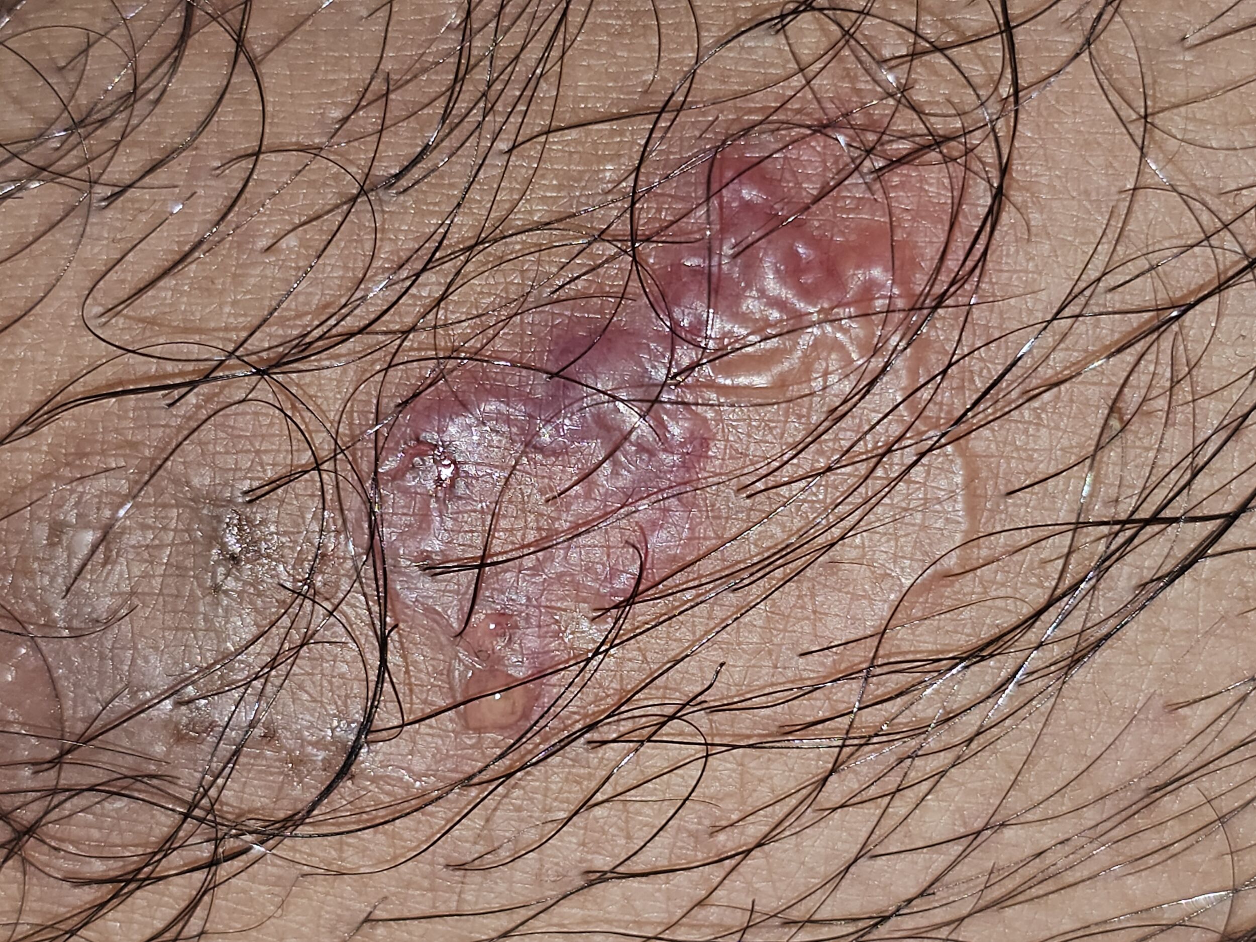 18-the-rash-that-crawled-dr-chetan-k-ganteppanavars-encounter-with-a-rare-diagnosis-image