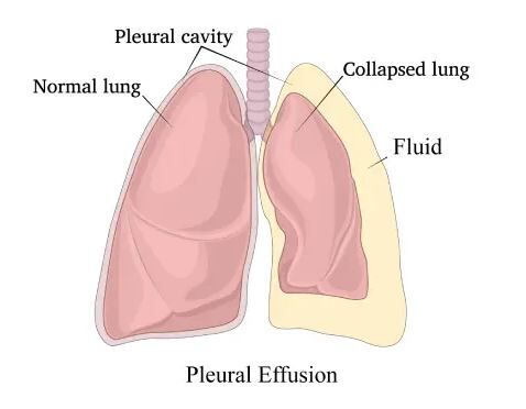 #20 Fluids in 3rd space : Dr Chetan K Ganteppanavar's routine encounter